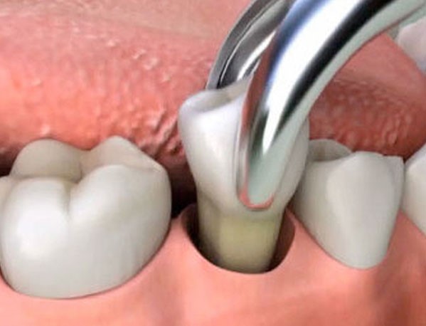 Painless Teeth Removal Treatment in Bangalore​