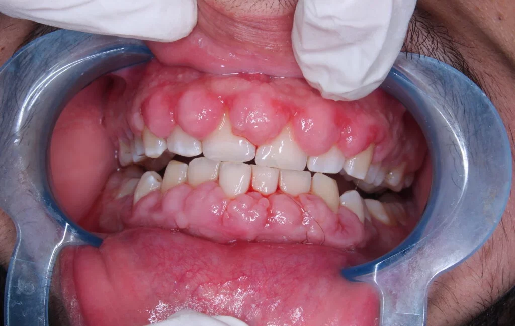 Gums over teeth